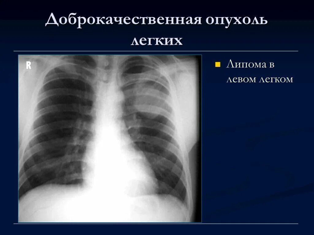 Доброкачественное образование легкого