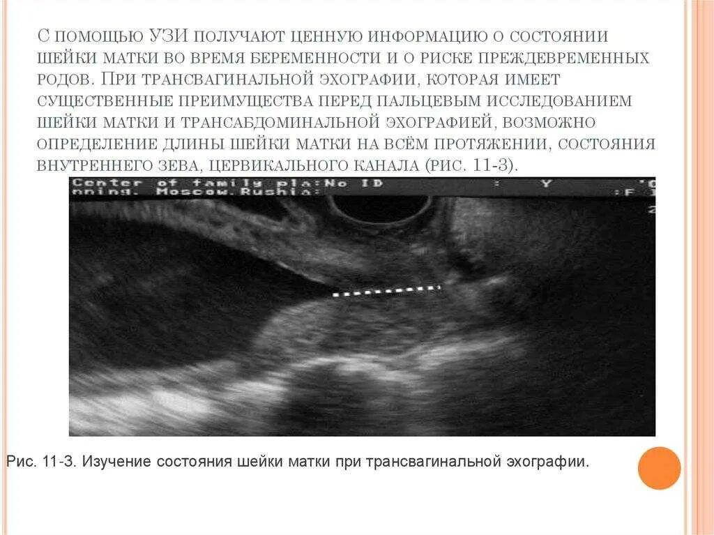 Ультразвуковое исследование матки при беременности. Ультразвуковое исследование шейки матки УЗИ-цервикометрия. Шейка матки цервикометрия.