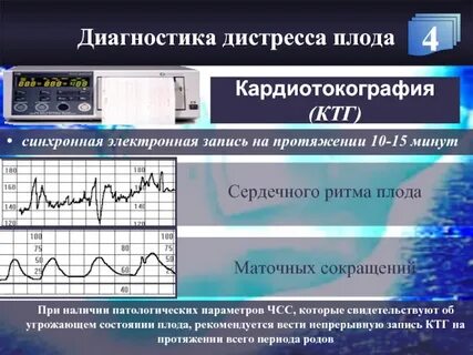 Дистресс плода