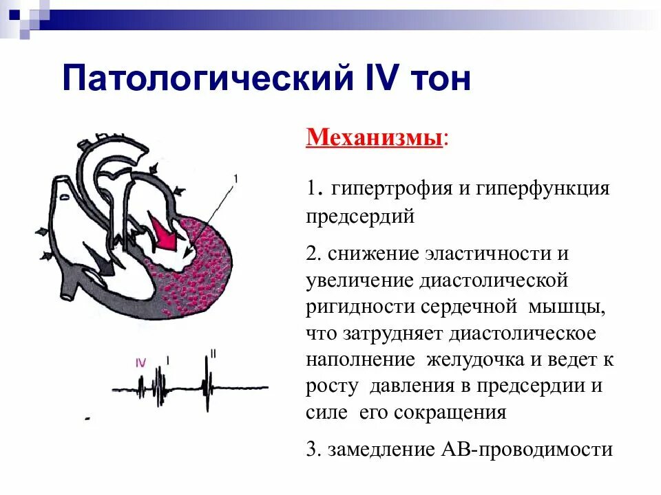 Ритм галопа при каком заболевании