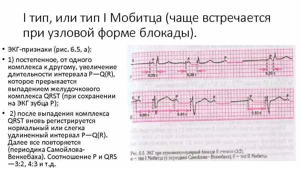Блокада это что означает. Атриовентрикулярная блокада 1 степени на экг. двухпучковая блокада на экг. ав блокада 3 ст. av блокада 2ст 2:1.