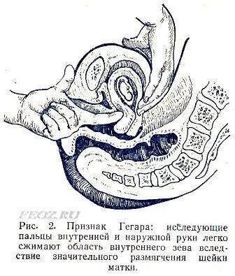 Контрольное ручное обследование полости матки. Бимануальное влагалищное исследование. Пальпация матки на ранних сроках. Шейка матки при беременности на ранних сроках. Инволюция шейки матки после родов.