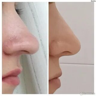 Кто делал ринопластику отзывы