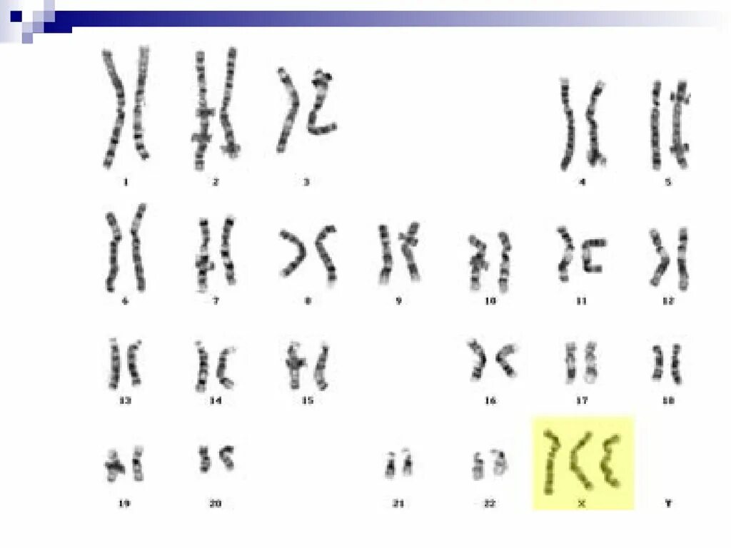 Полисомия кариотип. Синдром трисомии х хромосомы. Полисомия по х-хромосоме кариотип. Синдром трипло-х кариотип. Фото трипло