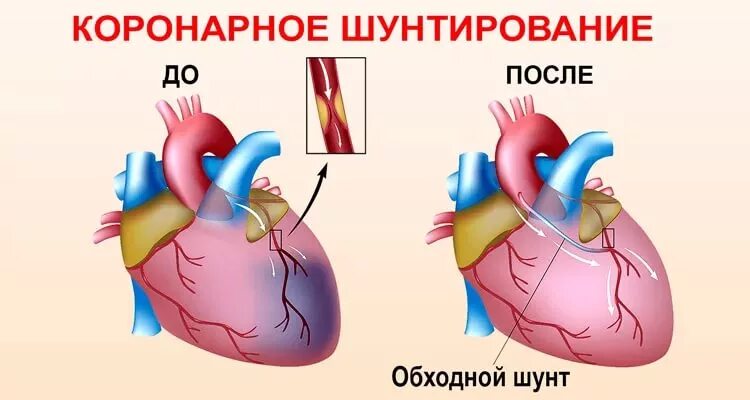 Что такое шунтирование сердца и сосудов. Шунт при инфаркте миокарда. коронарное шунтирование сосудов сердца. операция коронарное шунтирование сосудов сердца. шунтирование коронарных артерий схема.