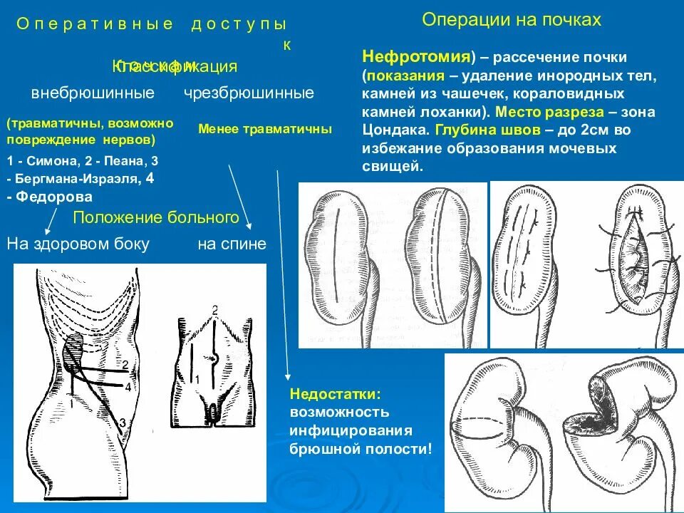 Классификация хирургических доступов к почкам и мочеточникам.. Оперативные доступы к почкам и мочеточникам. Виды оперативных доступов к почке. Оперативные доступы к почке. Резекция почки что это