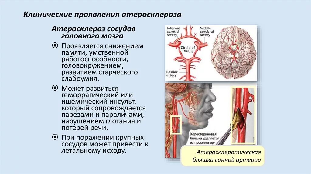 Болезни сосудов головы. Клинические проявления атеросклероза сосудов головного мозга. Клинические проявления атеросклероза мозговых артерий. Атеросклеротическое поражение магистральных артерий головы. Атеросклероз магистральных артерий головы симптомы.