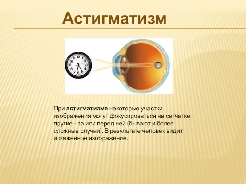 Астигматизм что это за болезнь. Астигматизм. легкий астигматизм. диагноз астигматизм. сложный астигматизм.