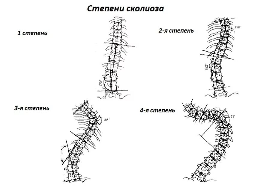 Сколиоз 2 степени это. S образный сколиоз позвоночника 2 степени. S образный сколиоз 3 степени. Степени сколиоза позвоночника с образный.