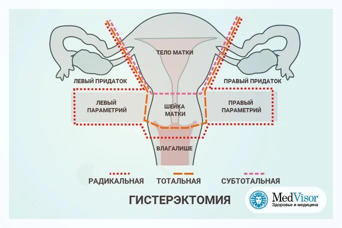 Половая жизнь на последнем. Радикальная гистерэктомия. Гистерэктомия и экстирпация матки.