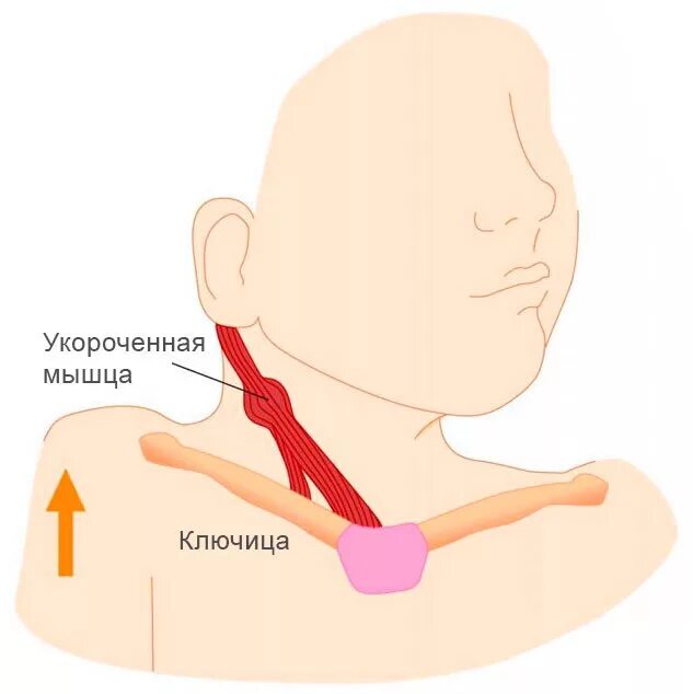 Кривошея признаки. Установочная кривошея.