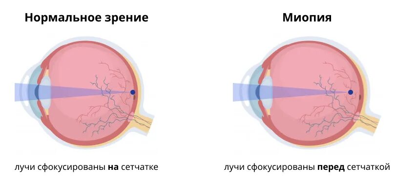 Вылечит ли близорукость операция. Астигматизм роговицы глаза. Что такое астигматизм зрения. Лазерная коррекция астигматизма. Лазерная коррекция гиперметропии.