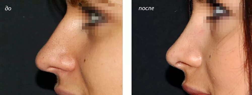 Нос после ковида. Ринопластика кончика носа Григорянц. Григорянц ринопластика до и после.