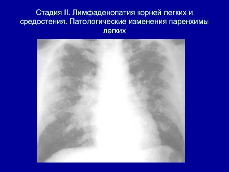 Изменения корня легкого. Саркоидоз диссеминация.