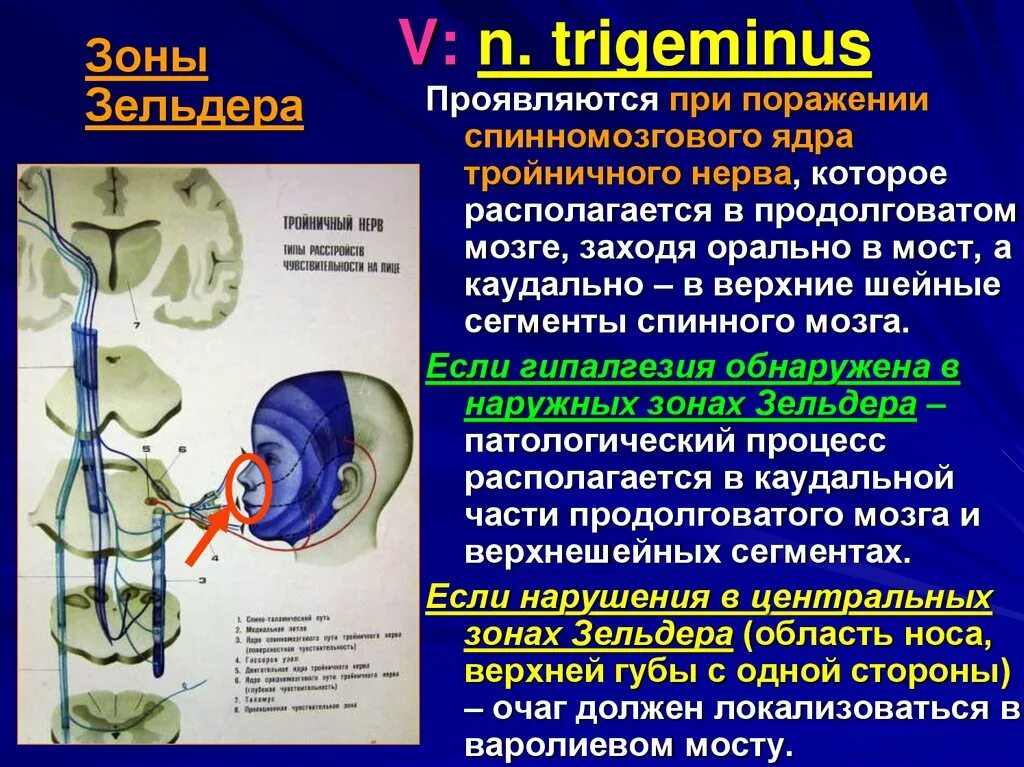 Отсутствие чувствительности латынь. Зоны Зельдера тройничного нерва. Тройничный нерв ядро чувствительность. Поражение ядра тройничного нерва. Зоны Зельдера неврология.