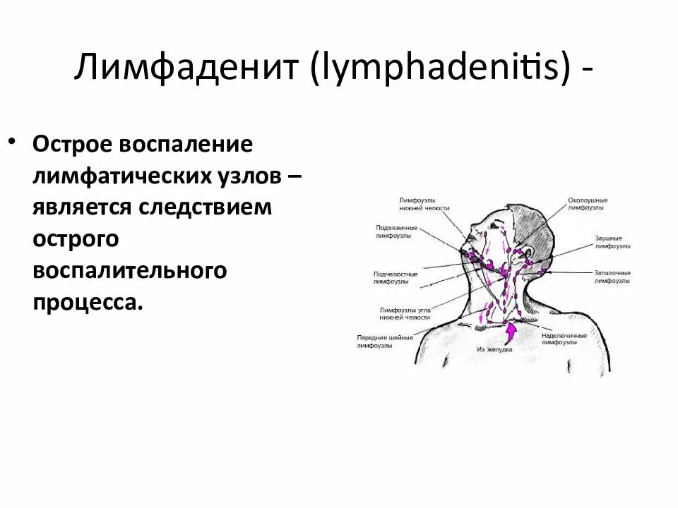 Болезненный узел. Лимфаденит это воспаление лимфатических. Лимфатические узлы шеи кт анатомия. Регионарные лимфоузлы поднижнечелюстные шейные. Схема подчелюстных лимфоузлов.