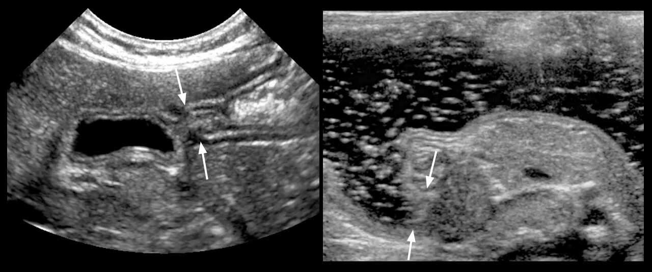 Стеноз привратника на УЗИ. Пилоростеноз УЗИ картина. УЗИ врожденного гипертрофического пилоростеноза. Пилоростеноз у новорожденных на УЗИ.