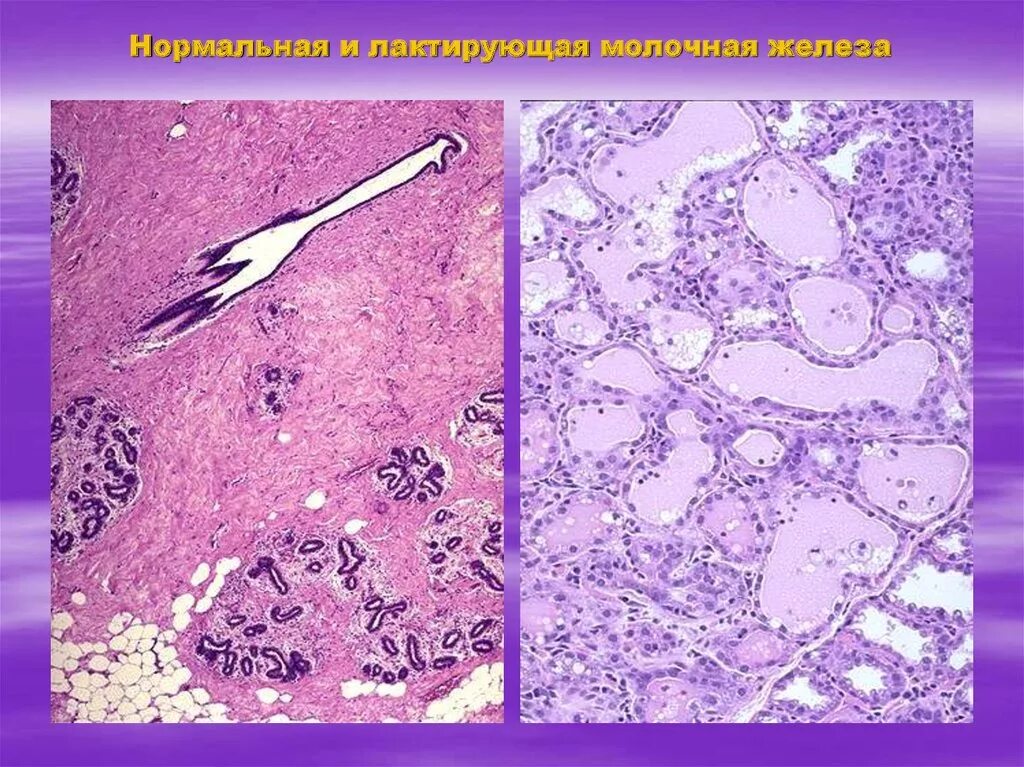 Гистология при беременности. Лактирующая молочная железа гистология. Лактирующая молочная железа гистология препарат. Молочная железа гистология препарат. Нелактирующая молочная железа гистология.