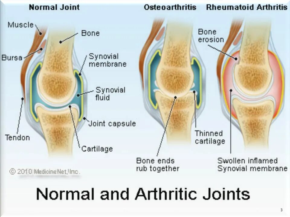 Остеоартроз что это такое как лечить. Ревматоидный артрит и артроз. Ревматоидный артрит и остеоартрит. Воспаление сустава артрит артроз. Разница между артритом и артрозом.