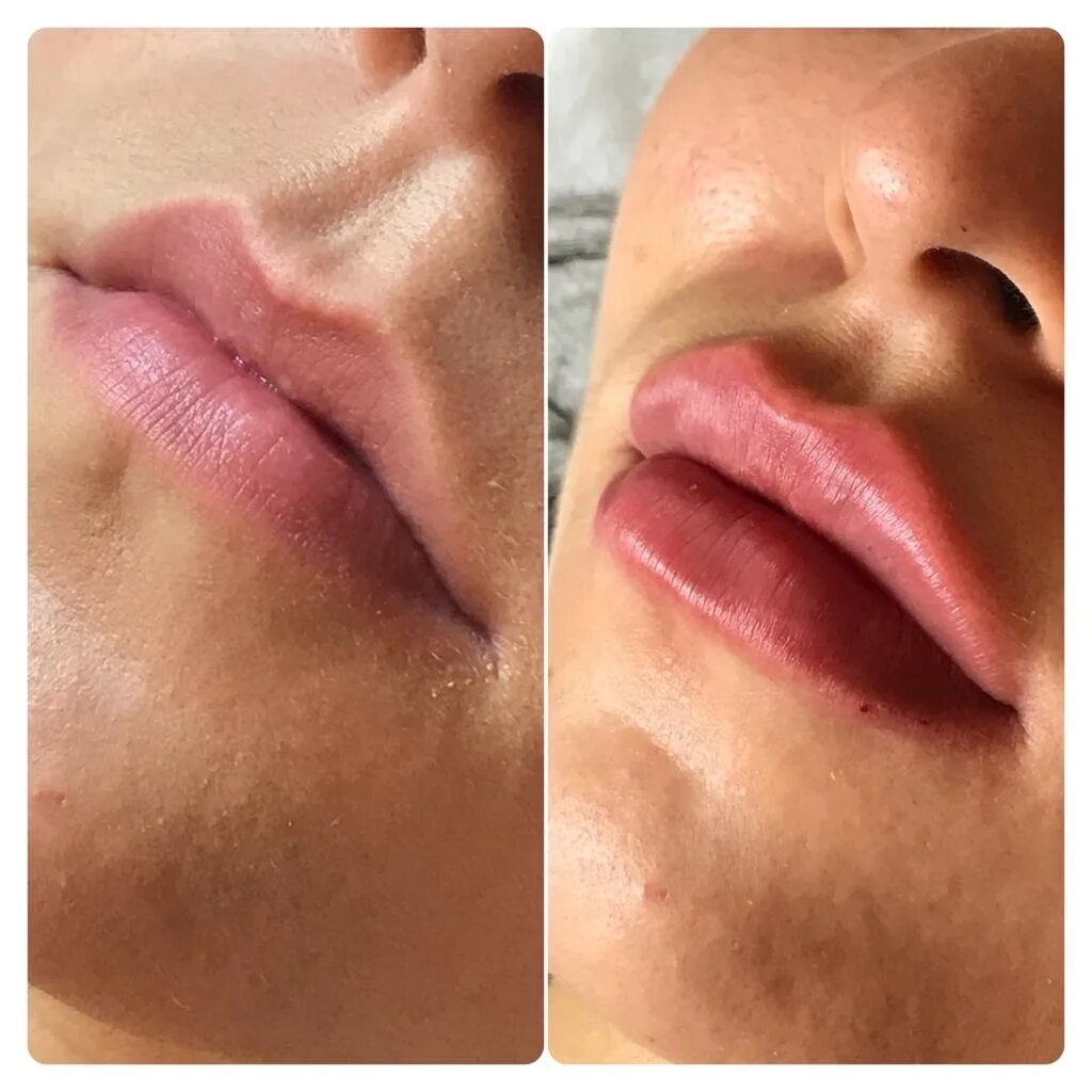 Увлажнение губ до и после. Тренд губ косметология 23. Процедура увлажнения губ фото до и после.
