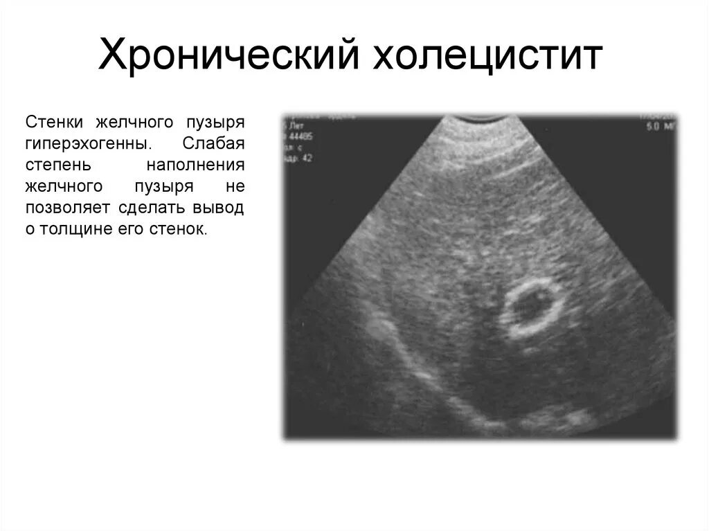 Эхопризнаки желчного пузыря. Холестероз желчного пузыря на УЗИ. Протокол УЗИ калькулезный холецистит хронический. Хронический холецистит УЗИ заключение. Острый калькулезный холецистит на УЗИ.