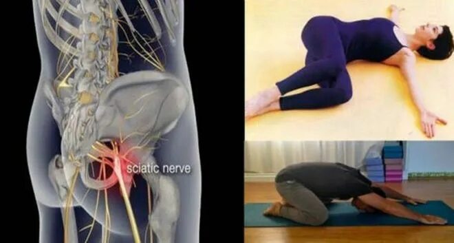 Защемление седалищного нерва Евдокименко. Седалищный нерв (sciatic nerve)? 011. Ишиас седалищного нерва йога упражнения. Поза при защемлении седалищного нерва. При защемлении можно греть