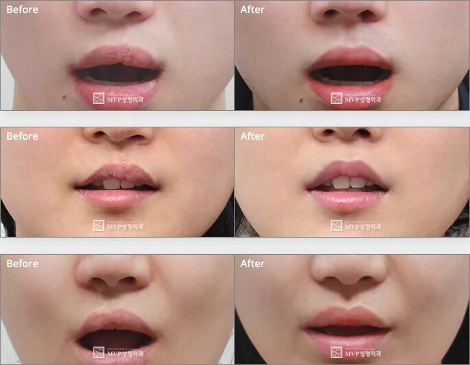 форма губ арка купидона.