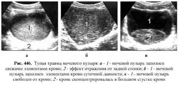 Неполное опорожнение мочевого у мужчины. Стенки мочевого пузыря на УЗИ. УЗИ исследование мочевого пузыря. Травма мочевого пузыря УЗИ. Ранение мочевого пузыря УЗИ.