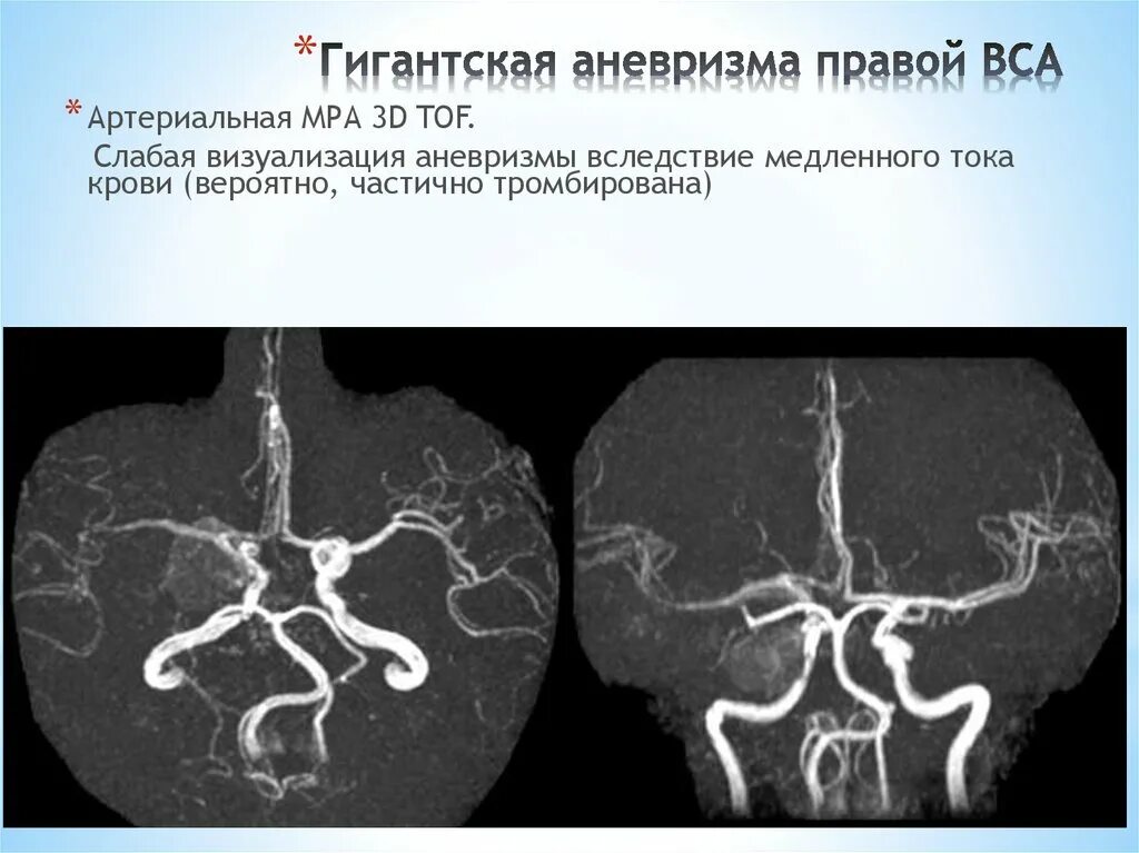 Аневризма супраклиноидного отдела ВСА. Мешотчатая аневризма а2. Ангиограмма аневризма. Мешотчатая аневризма мрт.