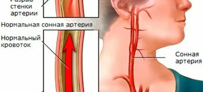 синдром барре-льеу (шейная мигрень). болит артерия на шее справа. болит артерия на шее справа. болит артерия на шее справа. внутренняя сонная артерия и внутренняя яремная вена.