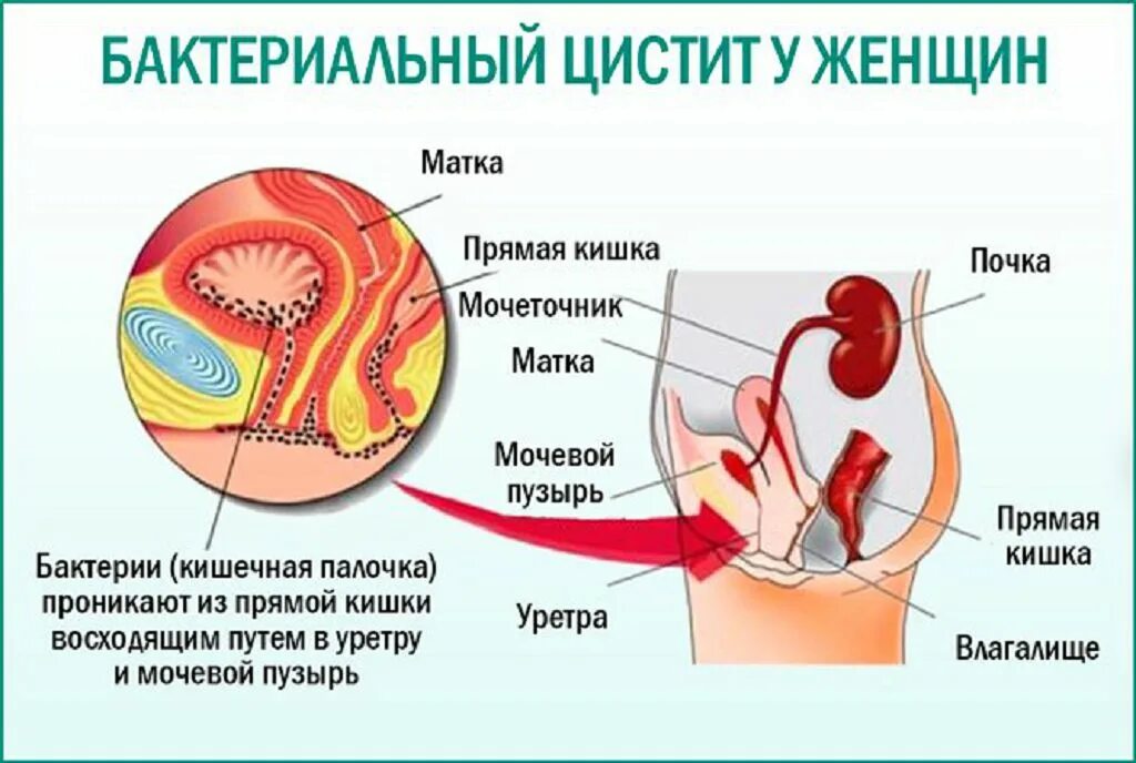 Воспаление мочевого пузыря у женщин лечение. Воспаление мочевого пузыря у женщин. цистит воспаление мочевого пузыря. цистит вызывается бактериями.