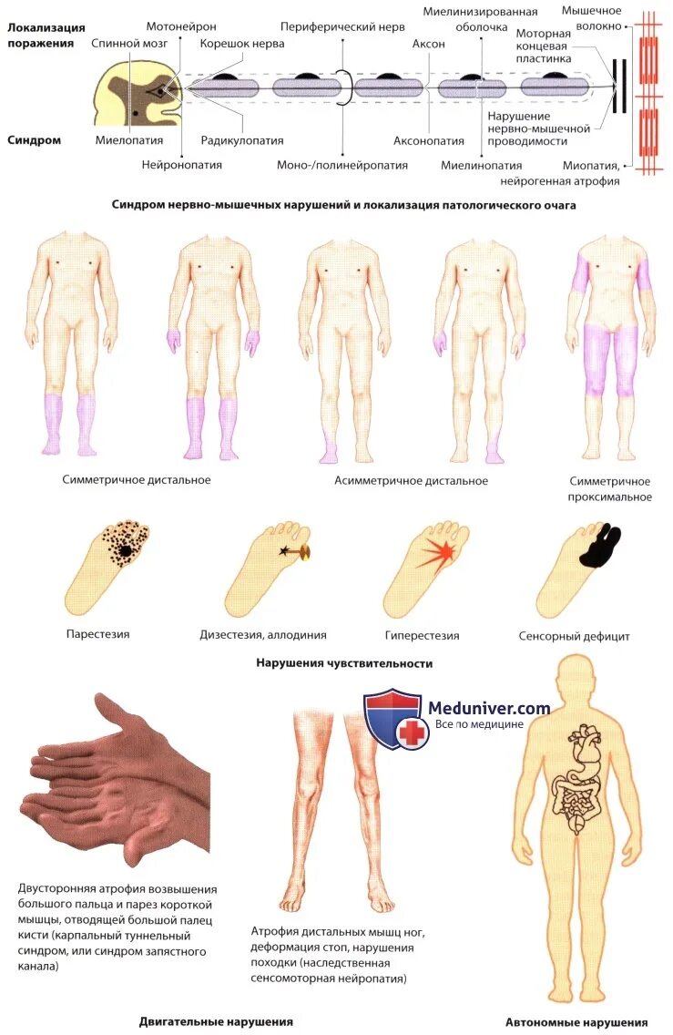Периферическая сенсорная нейропатия. Психогенная нейропатия. Нейропатия левой стороны тела. Поражение периферических нервов нижних конечностей. Нейропатия слева