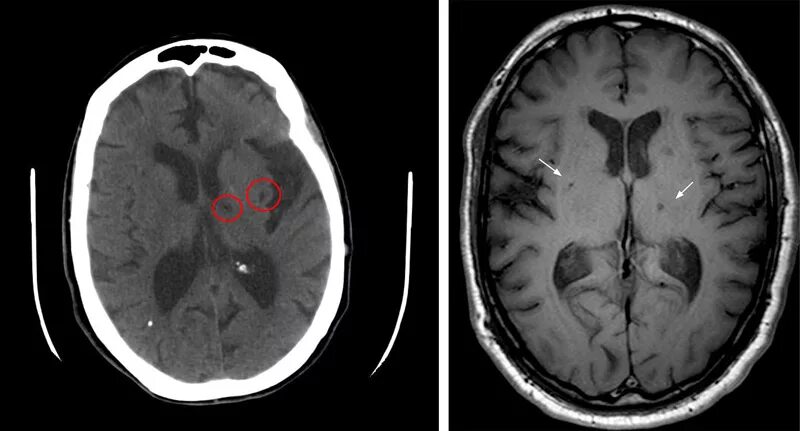 Вазогенный очаг больших полушарий. Дисциркуляторная энцефалопатия головного мозга на кт. Очаговые изменения вещества головного мозга дисциркуляторного. Лакунарный инсульт кт. Инсульт височной доли.