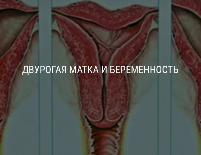 Аномалия матки двурогая. Двурогая матка патология. Что такое двурогая матка