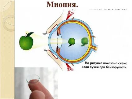 Признаки миопии