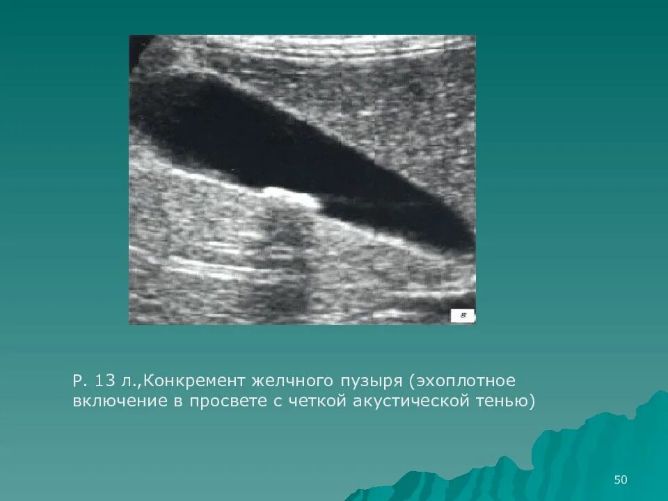 Образование без акустической тени. Акустическая тень на УЗИ желчного пузыря. Гиперэхогенные включения в желчном пузыре. Конкремент в желчном пузыре без акустической тени. Гиперэхогенное образование в желчном пузыре.