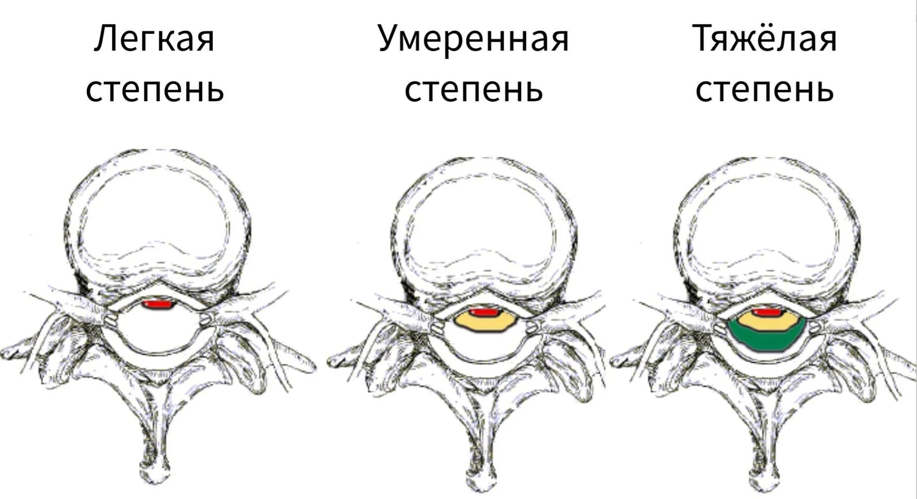 Диффузная протрузия диска l5 s1. Протрузия диска l5-s1. парамедианная протрузия диска. правосторонняя парамедианная грыжа. парамедианная грыжа межпозвонкового диска.