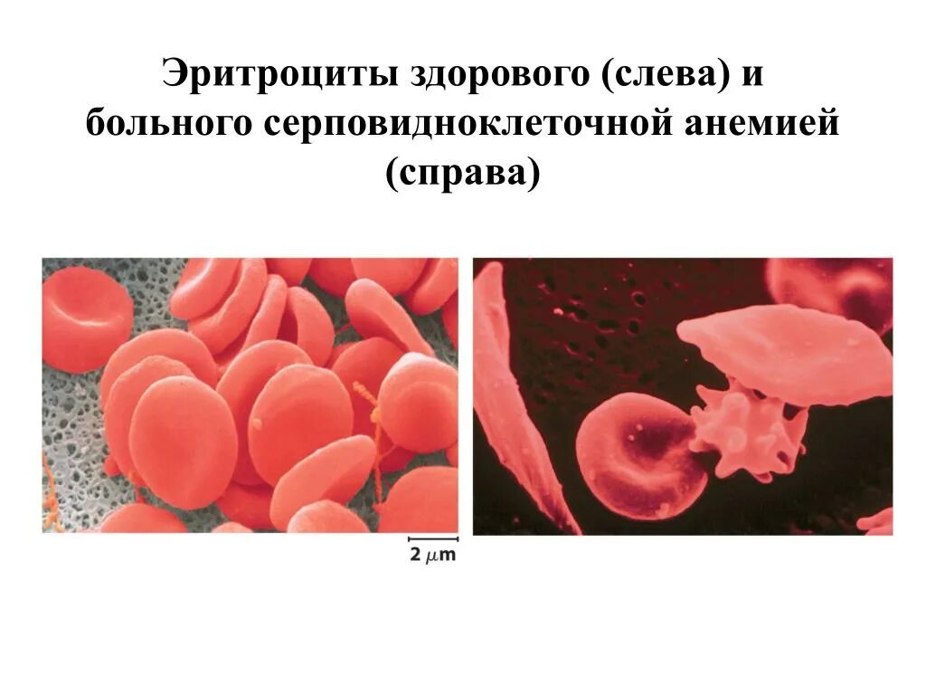 Здоровый эритроцит. Серповидноклеточная анемия. эритроциты. анемия эритроциты здорового и больного. эритроциты при серповидноклеточной анемии.