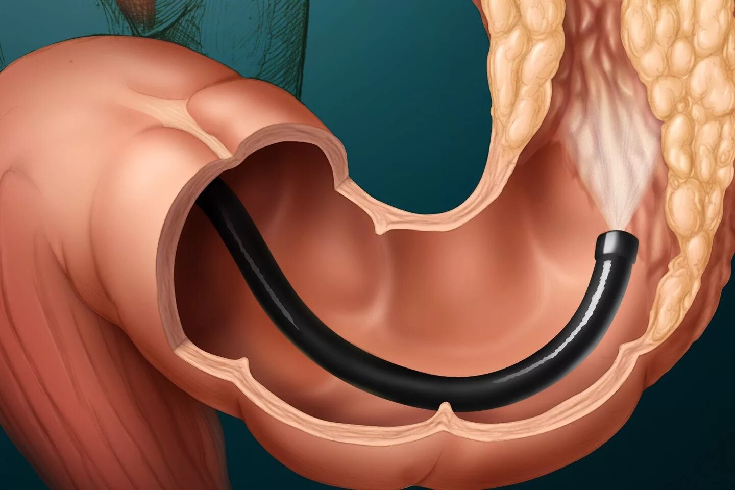 Колоноскопия или фиброколоноскопия. Полипы толстой кишки колоноскопия. Колоноскопия ободочной кишки. Полипы прямой кишки колоноскопия. Кишечник изнутри колоноскопия.