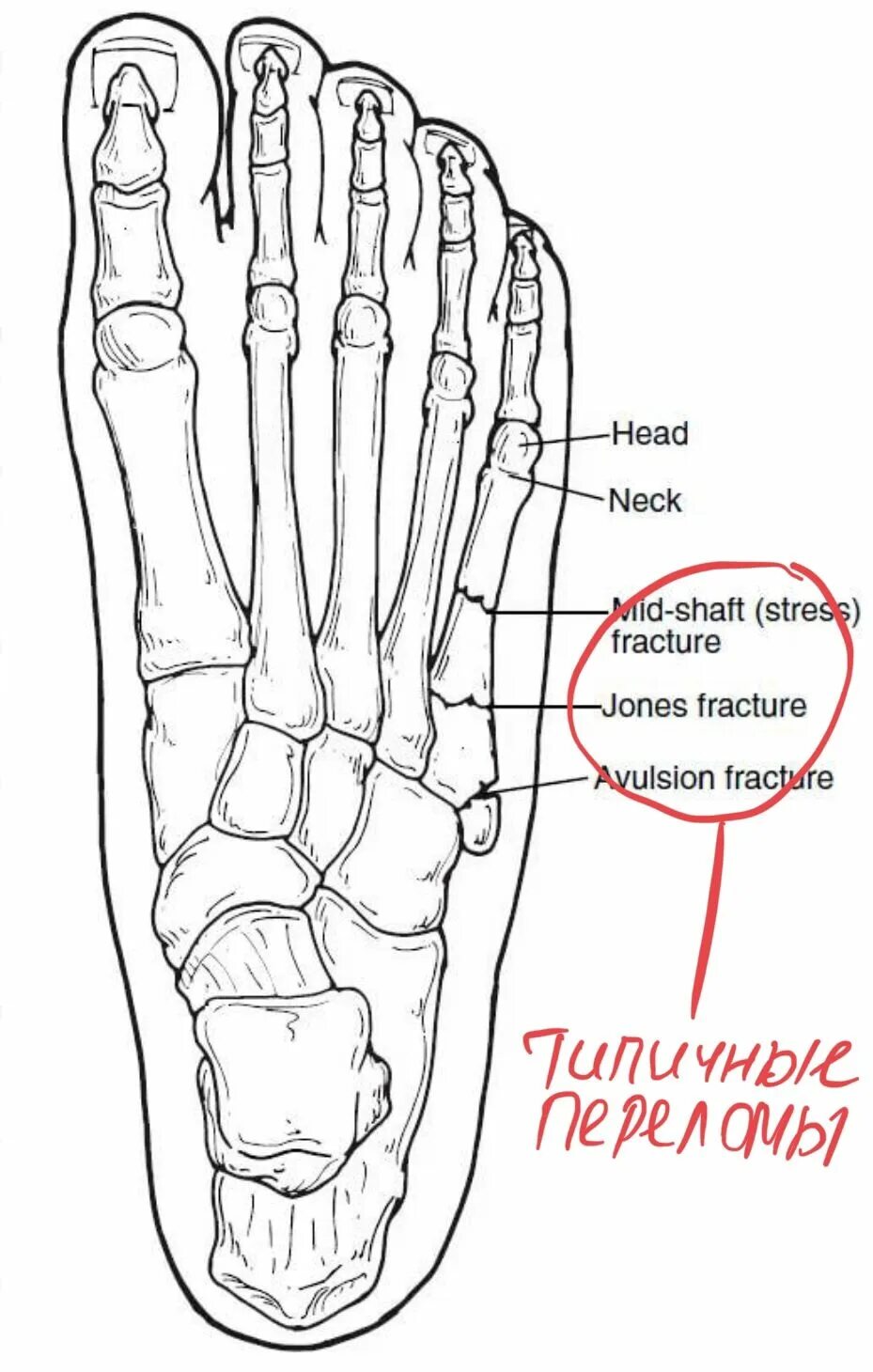 Стора передом плюсневой кости. 5 Плюсневая кость стопы строение. 5 Плюсневая кость стопы перелом. Анатомия 5 плюсневой кости стопы. Перелом подошвы