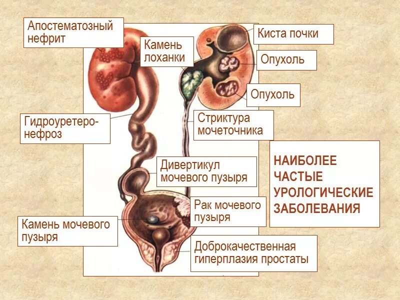 Дивертикул мочевого пузыря классификация. Воспаление мочеточника.