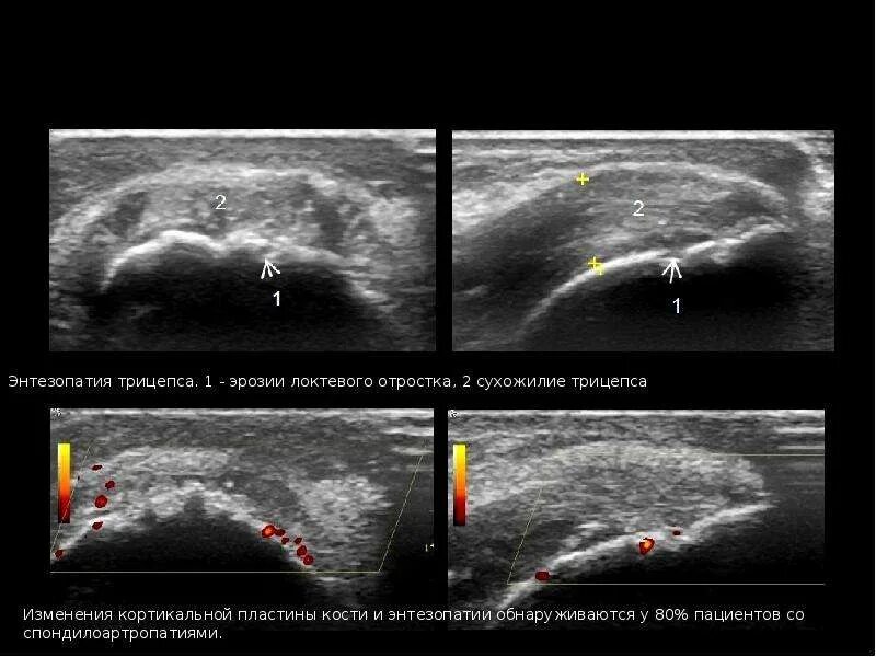 Энтезопатия что это. Локтевой сустав УЗИ Диагностер. Энтезопатия коленного сустава УЗИ. Энтезопатии на УЗИ. УЗИ локтевого сустава норма.