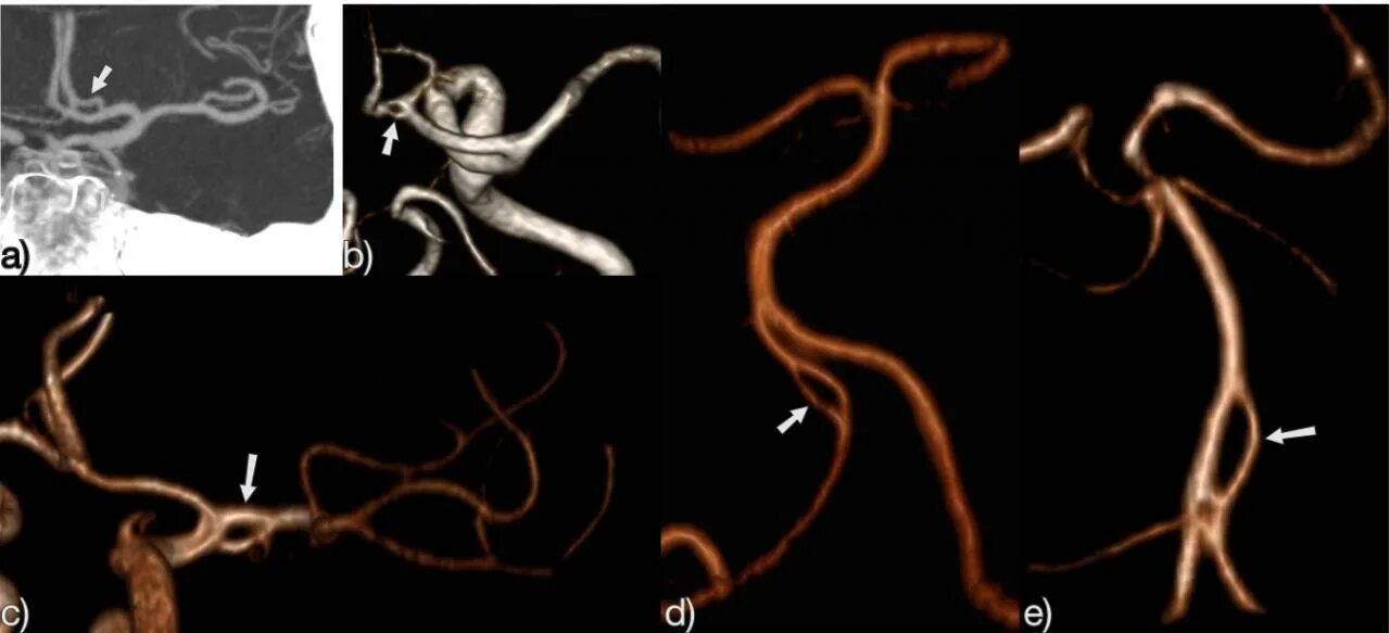 Изгиб вса. Фенестрация основной артерии головного мозга. Фенестрация основной артерии кт. А1 сегмент правой позвоночной артерии.