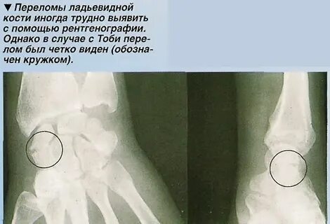 Ладьевидный бугорок