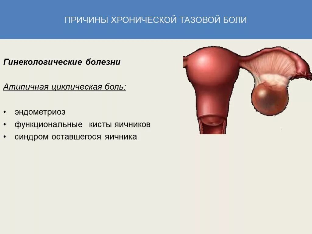 Болит правая сторона яичников. Гинекологические заболевания. Функциональные кисты яичников.