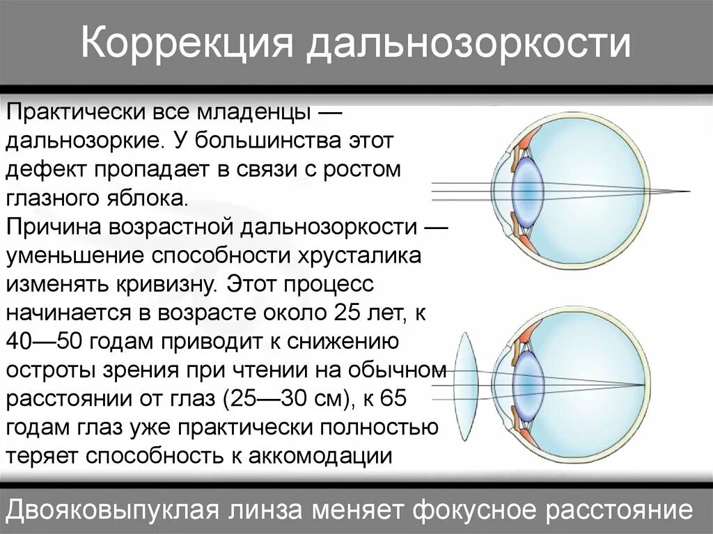 Как можно скорректировать дальнозоркость. Патология рефракции гиперметропия. Аномалии рефракции глаза близорукость дальнозоркость таблица. Гиперметропия клинические рекомендации 2022. Коррекция пресбиопии при близорукости.
