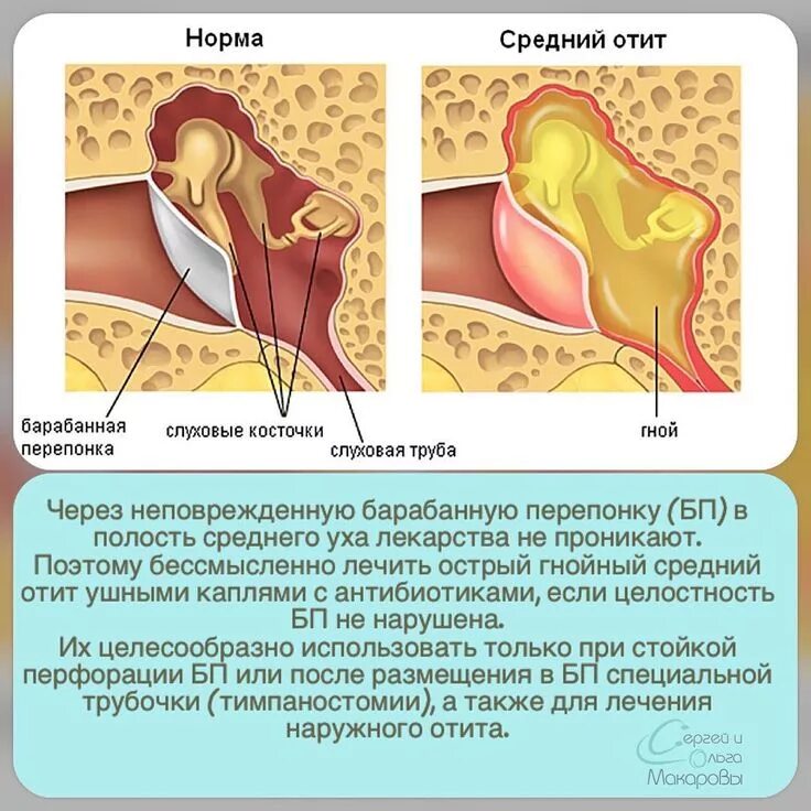 Барабанная перепонка при отите. Ушные капли при перфорированной барабанной перепонке. Гнойный отит среднего уха.