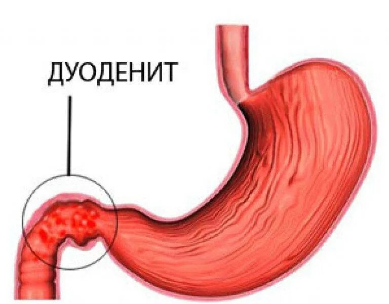 Дуоденит 12 перстной кишки. Язвенная болезнь 12 перстной кишки.