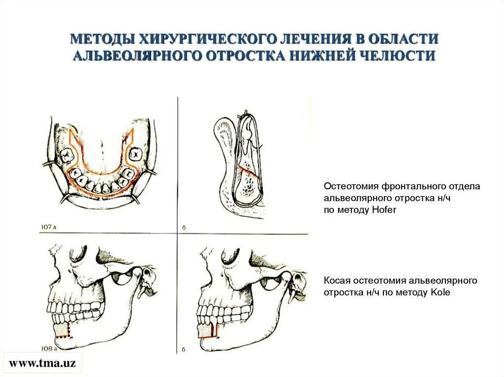 атрофия альвеолярного отростка верхней челюсти. альвеолярный отросток челюсти атрофия. слизистая альвеолярного отростка нижней челюсти. тип атрофии альвеолярного отростка по оксману. слизистая альвеолярного отростка нижней челюсти.