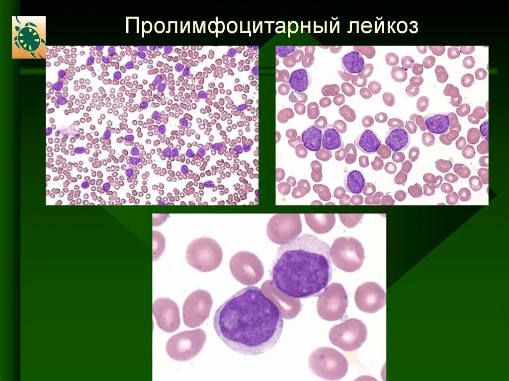 Лейкоз риск развития. Острый и хронический лимфобластный лейкоз. Фаб (fab)- классификация острых лейкозов. Миелопероксидаза при миелобластном лейкозе. При остром лейкозе часто развивается.
